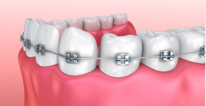 So Sánh Các Loại Niềng Răng, Nên Niềng Răng Loại Nào Cho Hiệu Quả Và An Toàn?