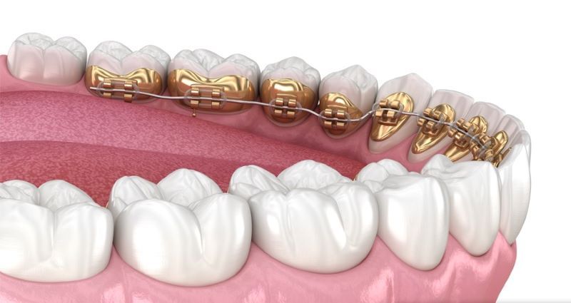 Niềng răng mắc cài mặt trong (lingual braces)