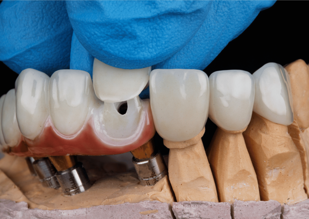 Cầu Răng Sứ và Cắm Ghép Implant