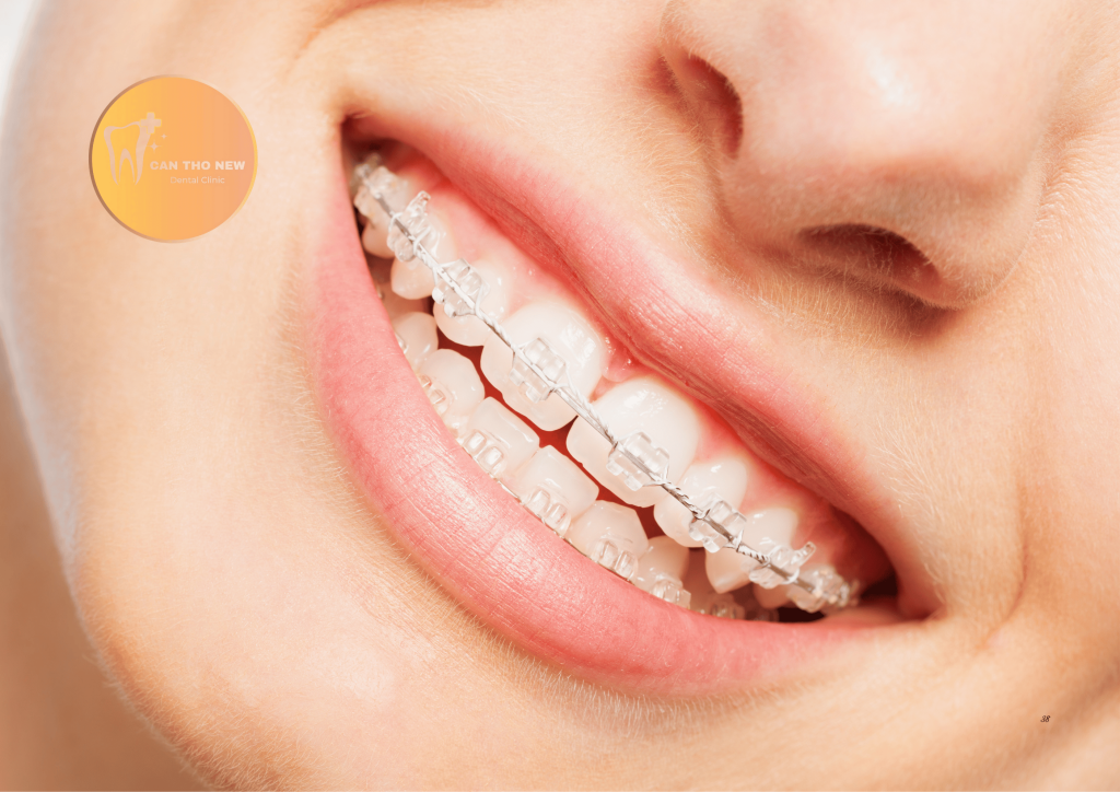 Giá niềng răng mắc cài sứ, niềng răng mắc cài sứ bao nhiêu tiền?