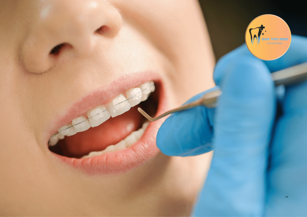 Tiêu Chí Vàng Chọn Địa Chỉ Niềng Răng Mắc Cài Sứ Uy Tín & Đẹp