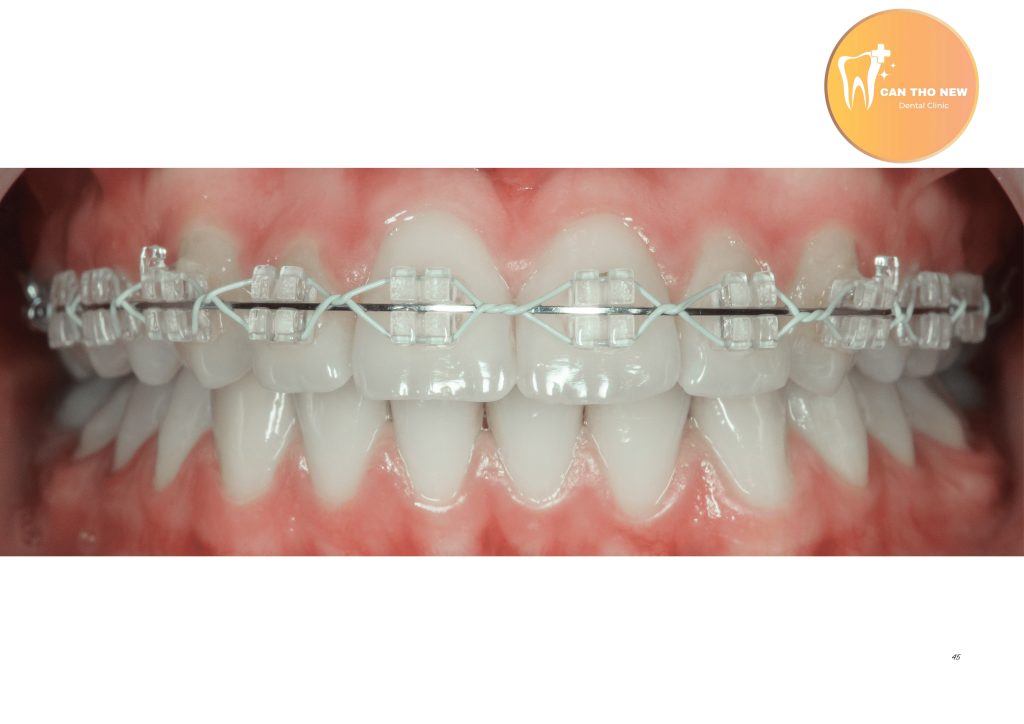 Niềng Răng Mắc Cài Sứ và Trong Suốt