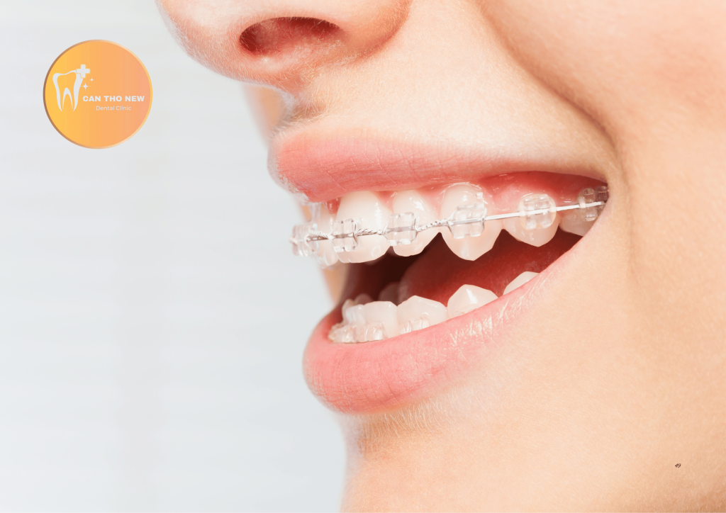 Tất Tần Tật Về Niềng Răng Mắc Cài Sứ Tự Buộc: Tại Sao Lại Đắt Hơn Mà Vẫn Được Săn Đón?