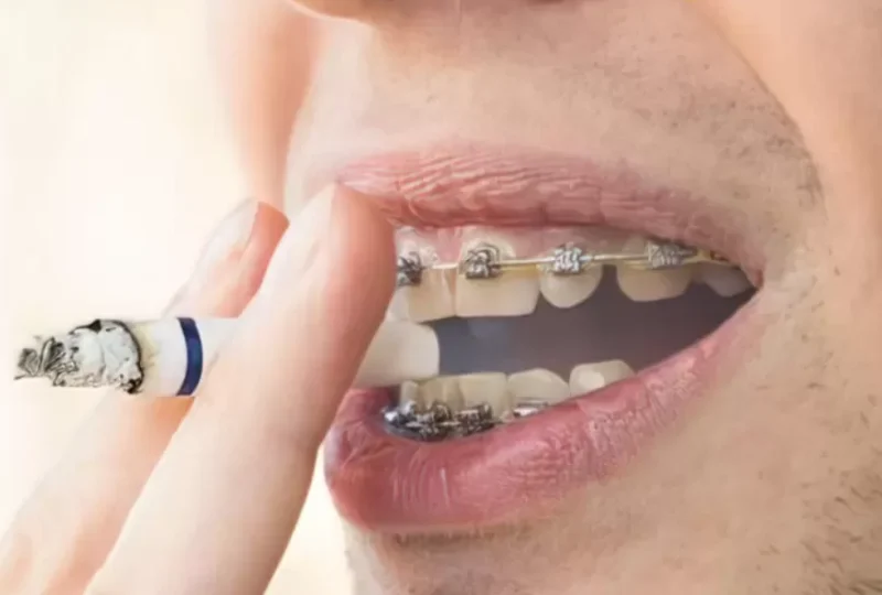 Hút thuốc khi đang niềng răng